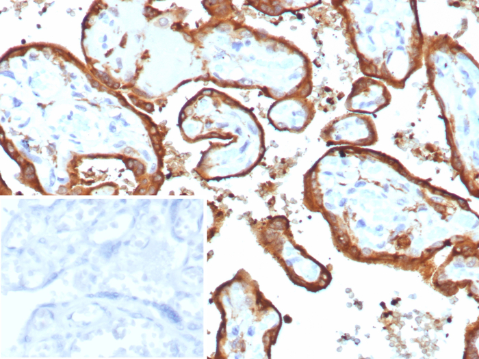 Formalin-fixed, paraffin-embedded human placenta stained with Chorionic Gonadotropin beta Chain (hCG beta) antibody (HCGa/7806R). Inset: PBS instead of primary antibody; secondary only negative control.