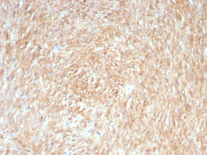Formalin-fixed, paraffin-embedded human GIST stained with DOG-1 Mouse Recombinant Monoclonal Antibody (rDG1/447). HIER: Tris/EDTA, pH9.0, 45min. 2: HRP-polymer, 30min. DAB, 5min.