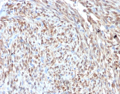 Formalin-fixed, paraffin-embedded human liposarcoma stained with CDK4 antibody (CDK4/7987R). HIER: Tris/EDTA, pH9.0, 45min. Secondary: HRP-polymer, 30min. DAB, 5min.