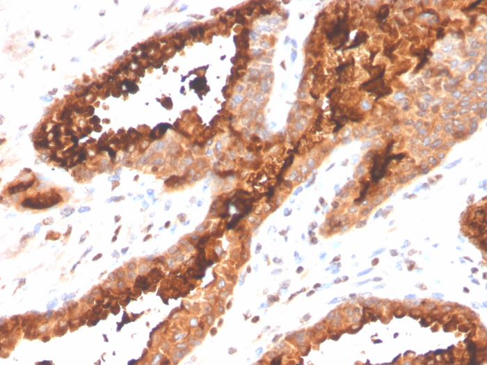 Formalin-fixed, paraffin-embedded human prostate carcinoma stained with Prostatic Acid Phosphatase/ACPP antibody (ACPP/4495R).