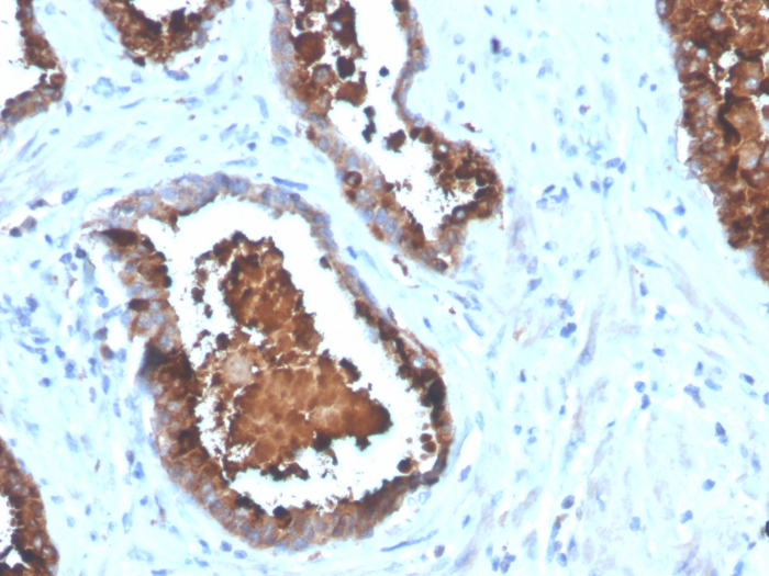 Formalin-fixed, paraffin-embedded human prostate carcinoma stained with Prostatic Acid Phosphatase/ACPP antibody (ACPP/4495R).