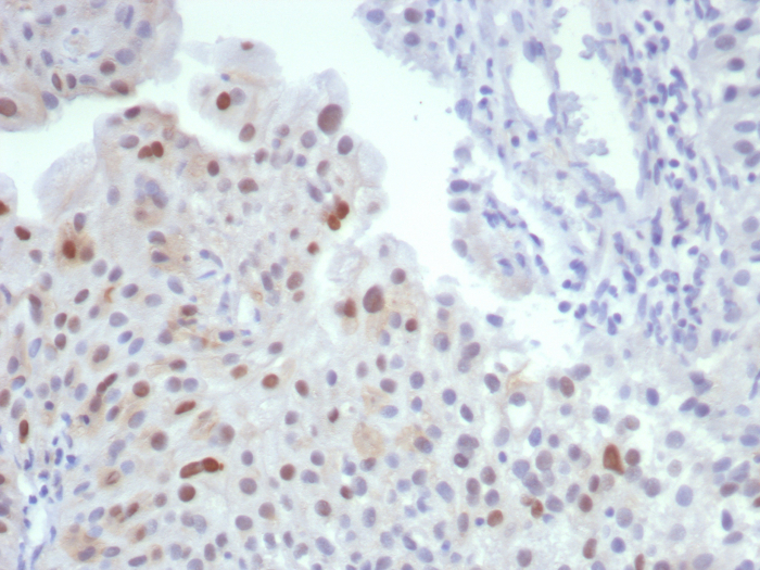 Formalin-fixed, paraffin-embedded human bladder stained with MDM2/HDM2 antibody (MDM2/7190R). HIER: Tris/EDTA, pH9.0, 45min. Secondary: HRP-polymer, 30min. DAB, 5min.