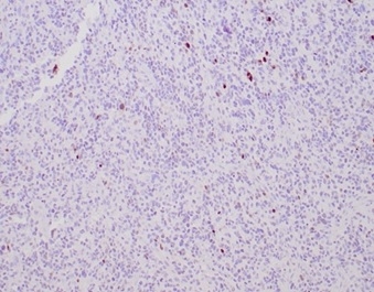 Formalin-fixed, paraffin-embedded human glioma stained with MGMT antibody (MGMT/4791).