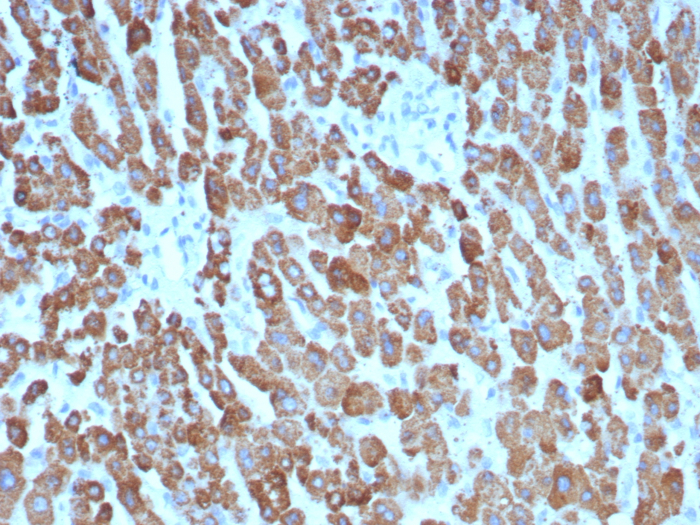 Formalin-fixed, paraffin-embedded human hepatocellular carcinoma stained with CPS1 antibody (CPS1/8416). HIER: Tris/EDTA, pH9.0, 45min. Secondary: HRP-polymer, 30min. DAB, 5min.