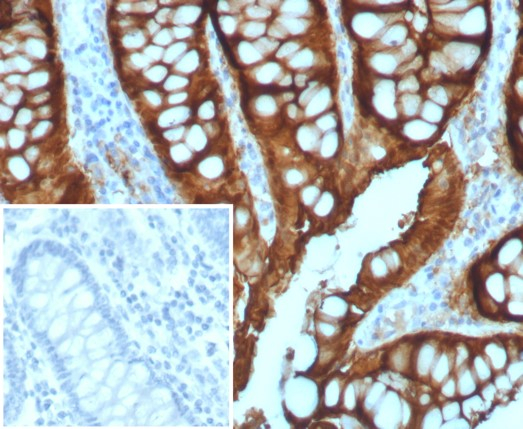 Formalin-fixed, paraffin-embedded human colon adenocarcinoma stained with Villin 1 antibody (VIL1/7378R). Inset: PBS instead of primary antibody; secondary only negative control.