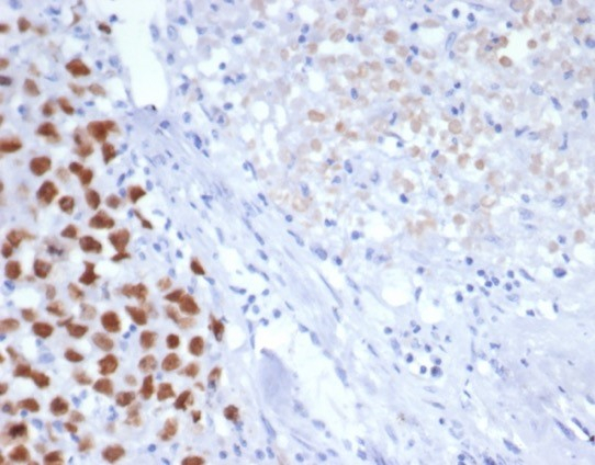 Formalin-fixed, paraffin-embedded human seminoma stained with SALL4 antibody (SALL4/7301R). HIER: Tris/EDTA, pH9.0, 45min. Secondary: HRP-polymer, 30min. DAB, 5min.