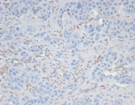 Formalin-fixed, paraffin-embedded human kidney cancer stained with SALL4 antibody (SALL4/7301R). HIER: Tris/EDTA, pH9.0, 45min. Secondary: HRP-polymer, 30min. DAB, 5min.