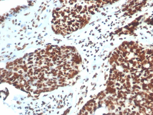 Formalin-fixed, paraffin-embedded human colon stained with Ku80/XRCC5 antibody (XRCC5/7316). HIER: Tris/EDTA, pH9.0, 45min. Secondary: HRP-polymer, 30min. DAB, 5min.