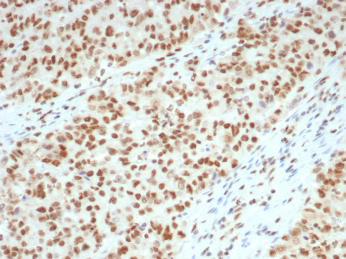 Formalin-fixed, paraffin-embedded human colon with Lynch disease stained with MLH1 antibody (MLH1/7562). HIER: Tris/EDTA, pH9.0, 45min. Secondary: HRP-polymer, 30min. DAB, 5min.