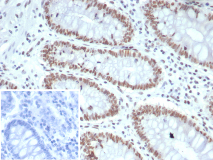 Formalin-fixed, paraffin-embedded human colon stained with MLH1 antibody (MLH1/7562). HIER: Tris/EDTA, pH9.0, 45min. Secondary: HRP-polymer, 30min. DAB, 5min.