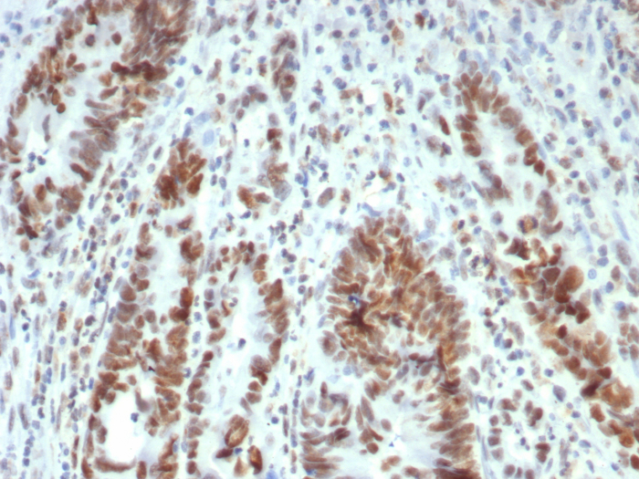 Formalin-fixed, paraffin-embedded human colon stained with MLH1 antibody (MLH1/7563). HIER: Tris/EDTA, pH9.0, 45min. Secondary: HRP-polymer, 30min. DAB, 5min.