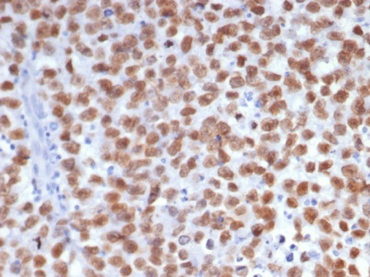 Formalin-fixed, paraffin-embedded human seminoma stained with SALL4 antibody (SALL4/7802). HIER: Tris/EDTA, pH9.0, 45min. Secondary: HRP-polymer, 30min. DAB, 5min.