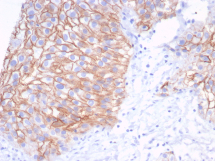 Formalin-fixed, paraffin-embedded human bladder stained with S100 calcium binding protein A14 antibody (S100A14/7401). HIER: Tris/EDTA, pH9.0, 45min. Secondary: HRP-polymer, 30min. DAB, 5min.