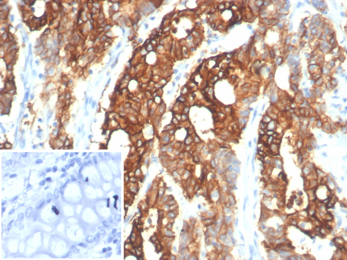 Formalin-fixed, paraffin-embedded human colon carcinoma stained with S100 calcium binding protein A14 antibody (S100A14/7401). Inset: PBS instead of primary antibody; secondary only negative control.