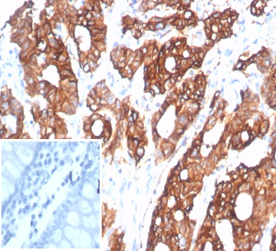 Formalin-fixed, paraffin-embedded human colon carcinoma stained with S100 calcium binding protein A14 antibody (S100A14/7402). Inset: PBS instead of primary antibody; secondary only negative control.