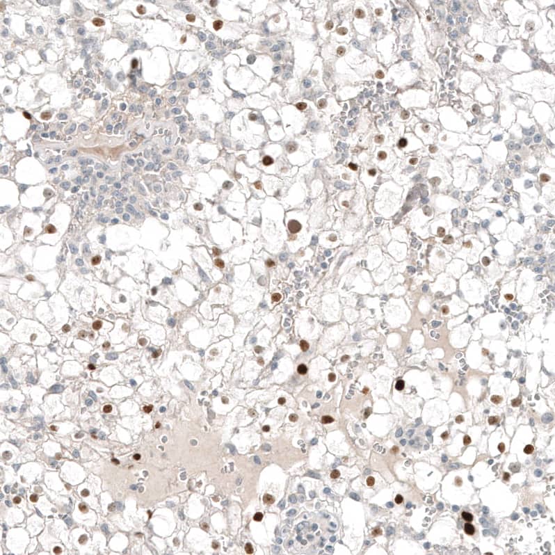 Staining of human renal cancer shows moderate to strong nuclear positivity in tumor cells.