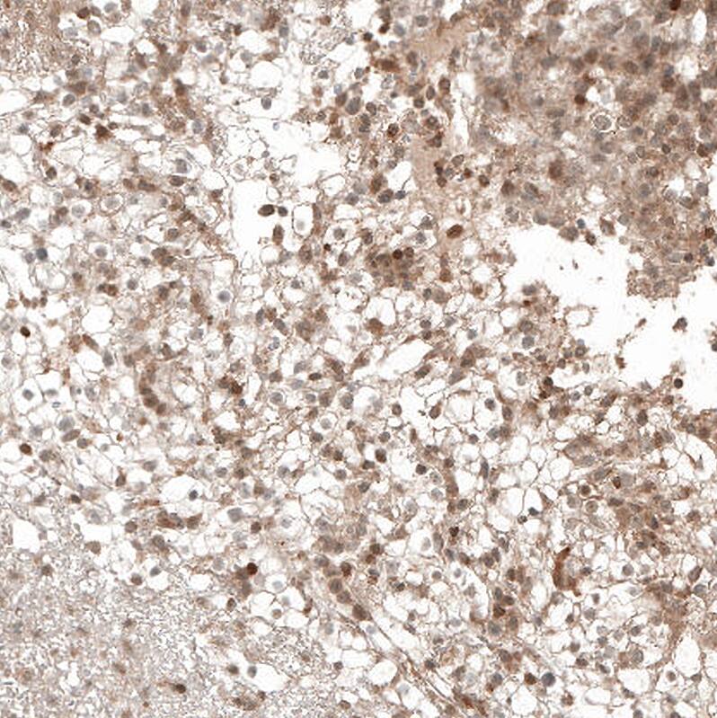 Staining of human renal cancer shows moderate cytoplasmic positivity.