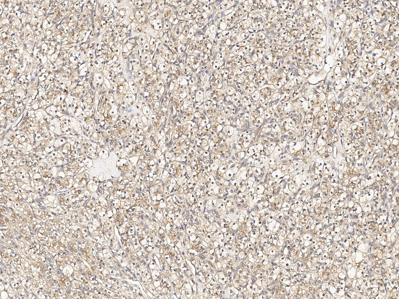 Immunochemical staining of LRP2 in formalin-fixed paraffin embedded sections of human renal carcinoma with NBP3-21426 at 1:100 dilution