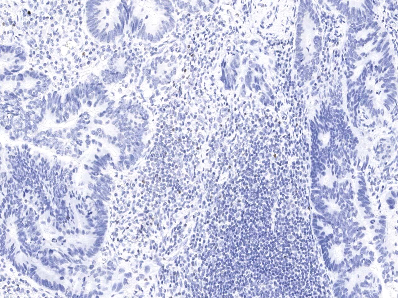 Immunohistochemistry-Paraffin: FoxP3 Antibody (02) [NBP3-21484] - Immunochemical staining of human FoxP3 in human carcinoma of sigmoid with NBP3-21484 at 1:200 dilution, formalin-fixed paraffin embedded sections.