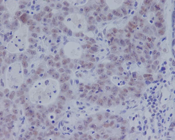 Immunohistochemistry: Smad3 [p Ser 423] Antibody (SR1995) [NBP3-21516] - Immunohistochemical analysis of paraffin-embedded human gastric adenocarcinoma, using NBP3-21516.