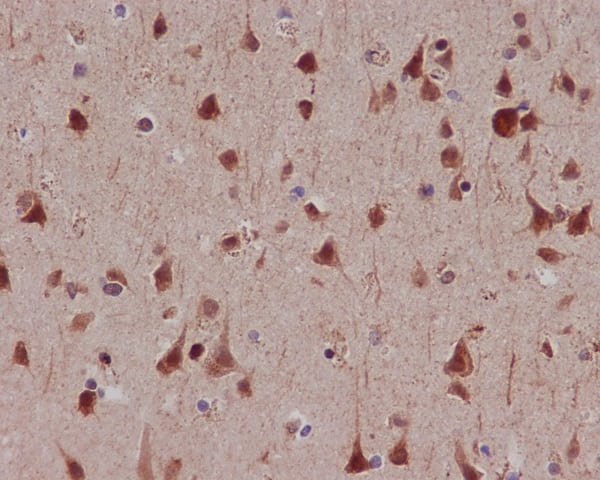 Immunohistochemistry: MSK1/RPS6KA5 [p Ser 376] Antibody (SR2276) [NBP3-21542] - Immunohistochemical analysis of paraffin-embedded human lung cancer, using NBP3-21542.