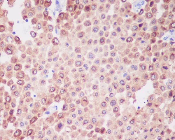 Immunohistochemistry: PMEL17/SILV Antibody (SR1021) [NBP3-21629] - Immunohistochemical analysis of paraffin-embedded human melanoma, using NBP3-21629.