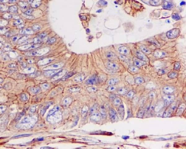 Immunohistochemistry: pan Cadherin Antibody (SR1156) [NBP3-21651] - Immunohistochemical analysis of paraffin-embedded colon cancer, using NBP3-21651.
