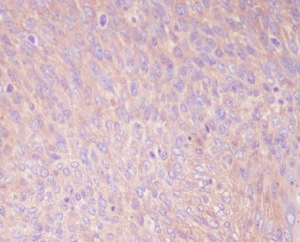 Immunohistochemistry: PKM2 Antibody (SR2031) [NBP3-21688] - Immunohistochemical analysis of paraffin-embedded human cervix cancer, using NBP3-21688.