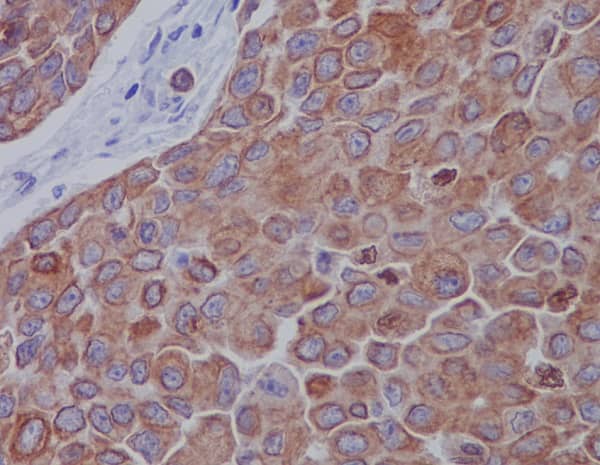 Immunohistochemistry: Mitofusin 2 Antibody (SR2236) [NBP3-21710] - Immunohistochemical analysis of paraffin-embedded human breast carcinoma, using NBP3-21710.