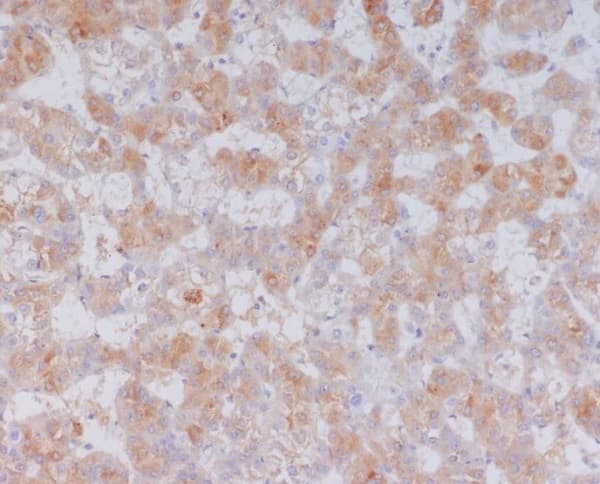 Immunohistochemistry: Serum Amyloid A1/A2 Antibody (SR1117) [NBP3-21727] - Immunohistochemical analysis of paraffin-embedded human liver cancer, using NBP3-21727.