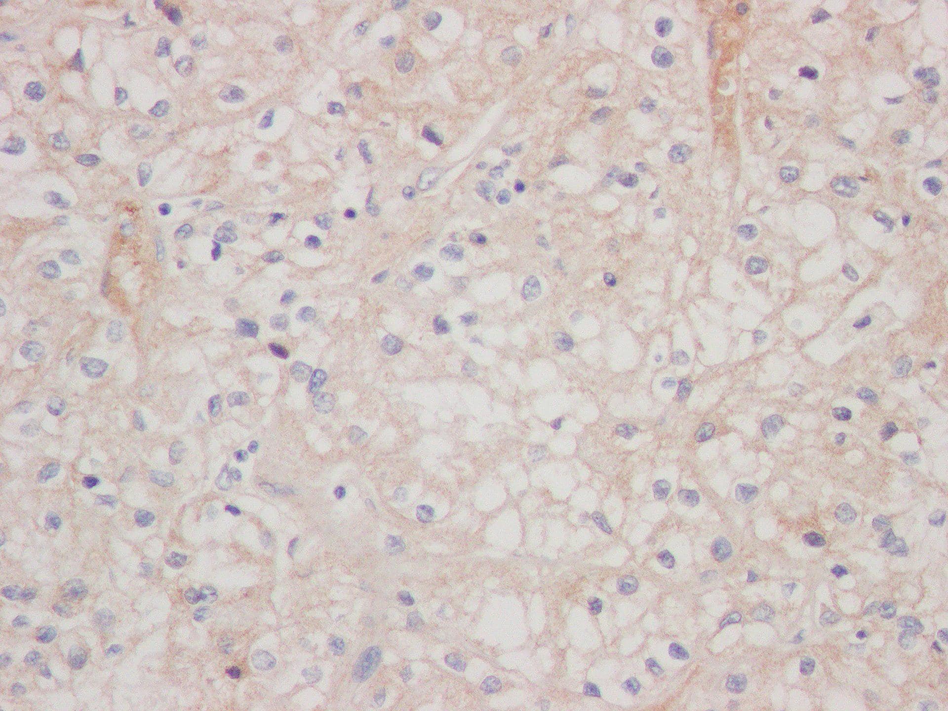 Immunohistochemical analysis of paraffin-embedded human Renal Clear Cell Carcinoma tissue using DARC Antibody (SR1582) - BSA Free.