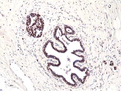 Immunohistochemistry-Paraffin: FoxP1 Antibody (RM402) [NBP3-23460] - Immunohistochemical staining of formalin fixed and paraffin embedded breast ductal carcinoma section using Clone RM402) at a 1:200 dilution.