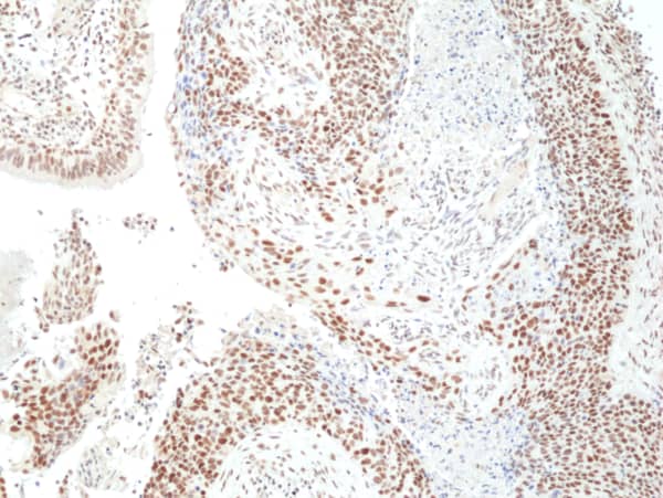 Immunohistochemistry-Paraffin: HDAC3 Antibody (RM439) [NBP3-23463] - Immunohistochemical staining of formalin fixed and paraffin embedded human lung squamous carcinoma tissue sections using Clone RM439) at 1:200 dilution.