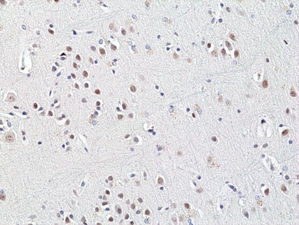 Immunohistochemistry-Paraffin: HDAC3 Antibody (RM439) [NBP3-23463] - Immunohistochemical staining of formalin fixed and paraffin embedded human brain cancer tissue sections using Clone RM439) at 1:200 dilution.