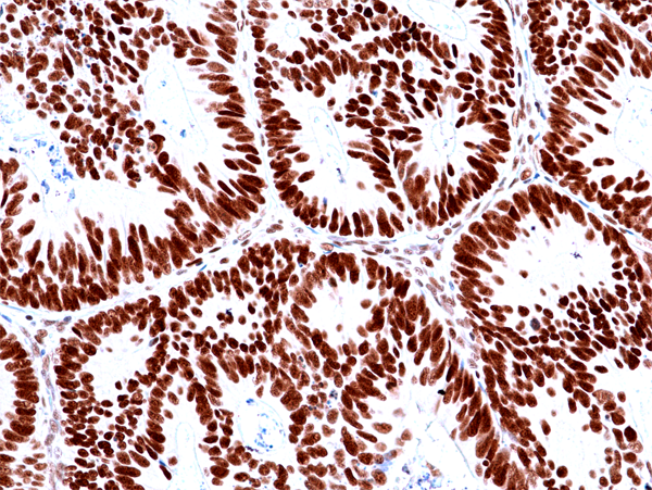 Immunohistochemistry-Paraffin: MSH2 Antibody (RM478) [NBP3-23464] - Immunohistochemical staining of formalin fixed and paraffin embedded human colon cancer tissues with MSH2 expression, using Clone RM478) at a 1:100 dilution.