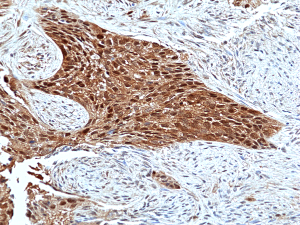 Immunohistochemistry-Paraffin: ERK2 Antibody (RM483) [NBP3-23465] - Immunohistochemical staining of formalin fixed and paraffin embedded human Lung Squamous Carcinoma tissue sections using Clone RM483) at 1:100 dilution.