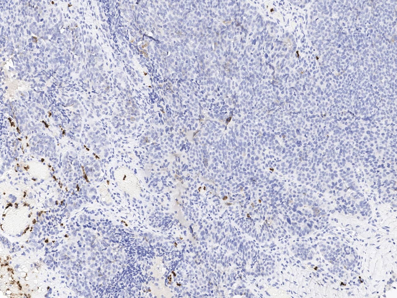 Immunohistochemistry-Paraffin: Lipocalin-2/NGAL Antibody (508) [NBP3-23485] - Immunochemical staining of human Lipocalin-2/NGAL in human ovarian cancer with NBP3-23485 at 1:1000 dilution, formalin-fixed paraffin embedded sections.