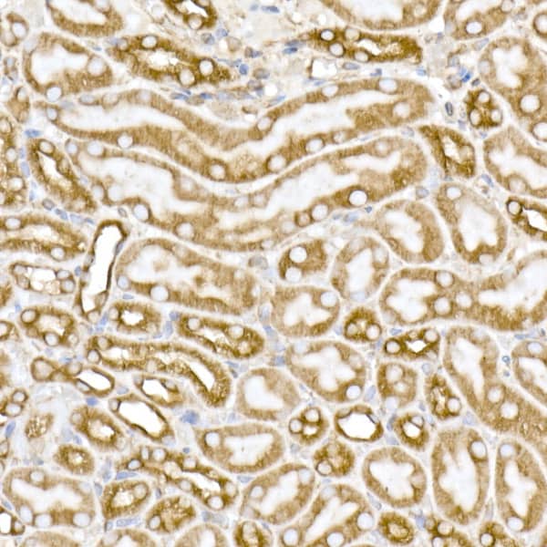 Immunohistochemistry: Tubulin alpha-1B Antibody (ARC51243) [NBP3-23538] - Immunohistochemistry analysis of paraffin-embedded Human cervix cancer tissue using Tubulin alpha-1B Rabbit mAb at a dilution of 1:200 (40x lens). High pressure antigen retrieval performed with 0.01M Citrate Bufferr (pH 6.0) prior to IHC staining.