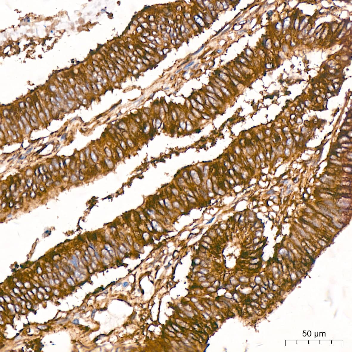 Immunohistochemistry: Tubulin alpha-1B Antibody  [NBP3-23538] - Immunohistochemistry analysis of Tubulin alpha-1B in paraffin-embedded human colon carcinoma tissue using Tubulin alpha-1B Rabbit mAb  at a dilution of 1:200 (40x lens).High pressure antigen retrieval was performed with 0.01 M citrate buffer (pH 6.0) prior to IHC staining.