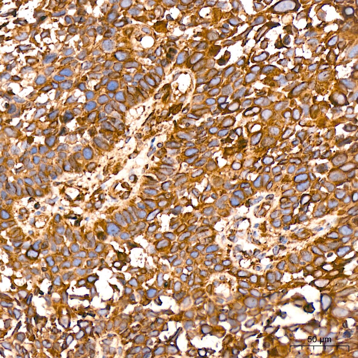 Immunohistochemistry: Tubulin alpha-1B Antibody  [NBP3-23538] - Immunohistochemistry analysis of Tubulin alpha-1B in paraffin-embedded human cervix cancer tissue using Tubulin alpha-1B Rabbit mAb  at a dilution of 1:200 (40x lens).High pressure antigen retrieval was performed with 0.01 M citrate buffer (pH 6.0) prior to IHC staining.