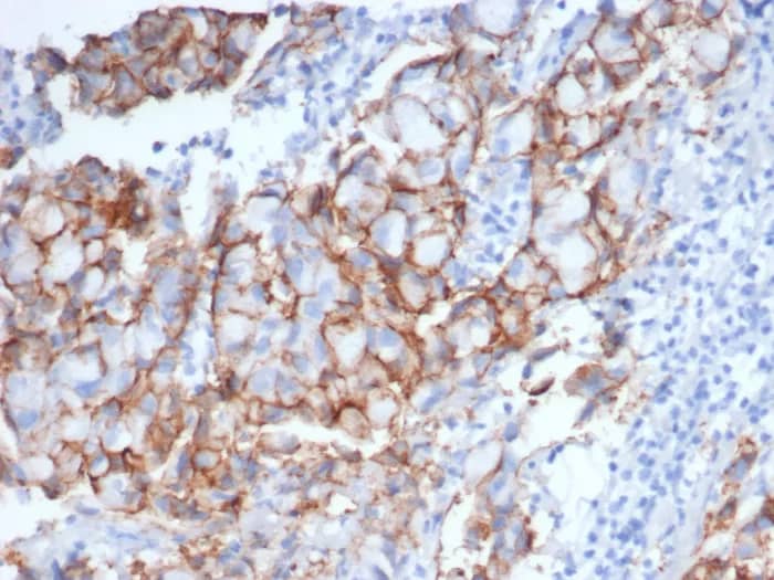 Immunohistochemistry-Paraffin: ErbB2/Her2 Antibody (rERBB2/6637) [NBP3-23581] - IHC analysis of formalin-fixed, paraffin-embedded human breast carcinoma. Stained using ErbB2/Her2 Antibody (rERBB2/6637) at 2ug/ml in PBS for 30min RT. HIER: Tris/EDTA, pH9.0, 45min. 2°C: HRP-polymer, 30min. DAB, 5min.
