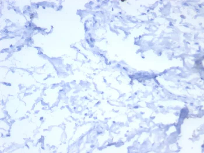 Immunohistochemistry-Paraffin: ErbB2/Her2 Antibody (ERBB2/7158R) [NBP3-23595] - IHC analysis of formalin-fixed, paraffin-embedded human breast stroma. Negative tissue control using ErbB2/Her2 Antibody (ERBB2/7158R). HIER: Tris/EDTA, pH9.0, 45min. 2°C: HRP-polymer, 30min. DAB, 5min.