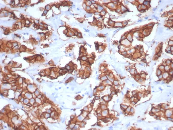 Immunohistochemistry-Paraffin: ErbB2/Her2 Antibody (ERBB2/7158R) [NBP3-23595] - Formalin-fixed, paraffin-embedded human breast carcinoma stained with ErbB2/Her2 Antibody (ERBB2/7158R). HIER: Tris/EDTA, pH9.0, 45min. 2°C: HRP-polymer, 30min. DAB, 5min.