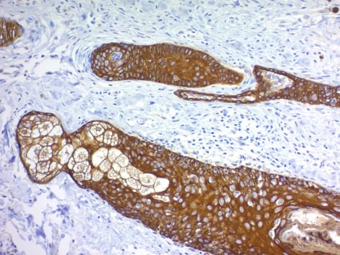 Immunohistochemistry-Paraffin: Cytokeratin, pan Antibody (MonoPoly/4999R) [NBP3-23627] - Formalin-fixed, paraffin-embedded human basal cell carcinoma stained with Cytokeratin, pan Antibody (MonoPoly/4999R)