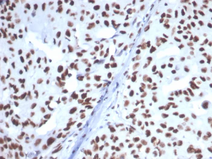 Formalin-fixed, paraffin-embedded human breast carcinoma stained with HspA1B antibody (HSPA1B/7628). HIER: Tris/EDTA, pH9.0, 45min. Secondary: HRP-polymer, 30min. DAB, 5min.