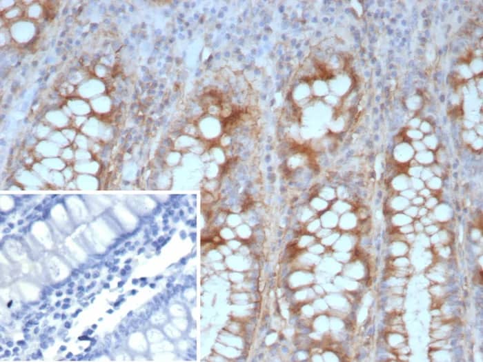 Immunohistochemistry-Paraffin: E-Cadherin Antibody (CDH1/9226R) [NBP3-23654] - Formalin-fixed, paraffin-embedded human colon carcinoma stained with E-Cadherin Antibody (CDH1/9226R). Inset: PBS instead of primary antibody; secondary only negative control.
