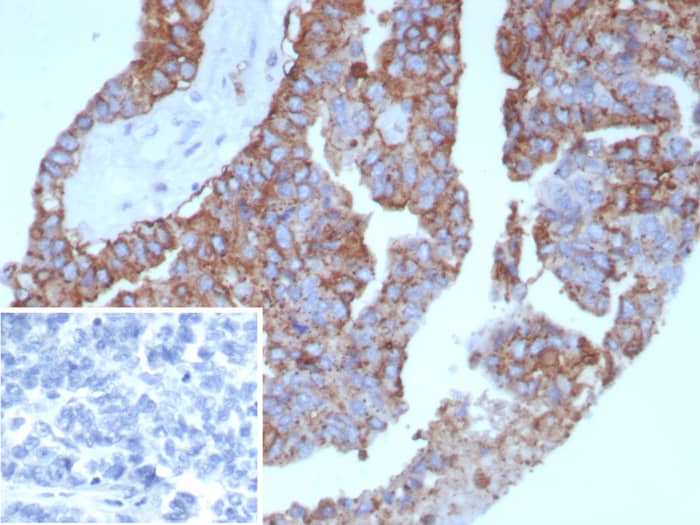 Formalin-fixed, paraffin-embedded human ovarian cancer stained with HLA DQ/DR/DP antibody (rHLA-Pan/8847). Inset: PBS instead of primary, secondary negative control.