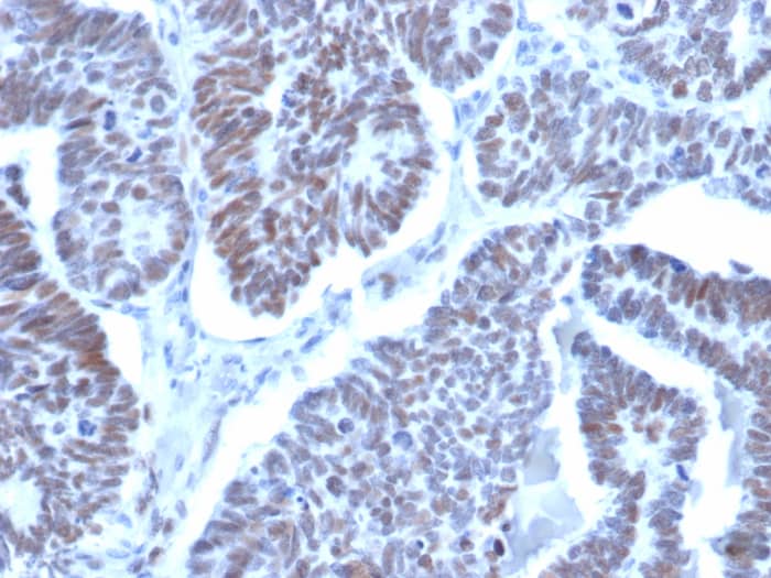 Formalin-fixed, paraffin-embedded human papillary thyroid cancer stained with LDB2 antibody (PCRP-LDB2-1B10). HIER: Tris/EDTA, pH9.0, 45min. Secondary: HRP-polymer, 30min. DAB, 5min.