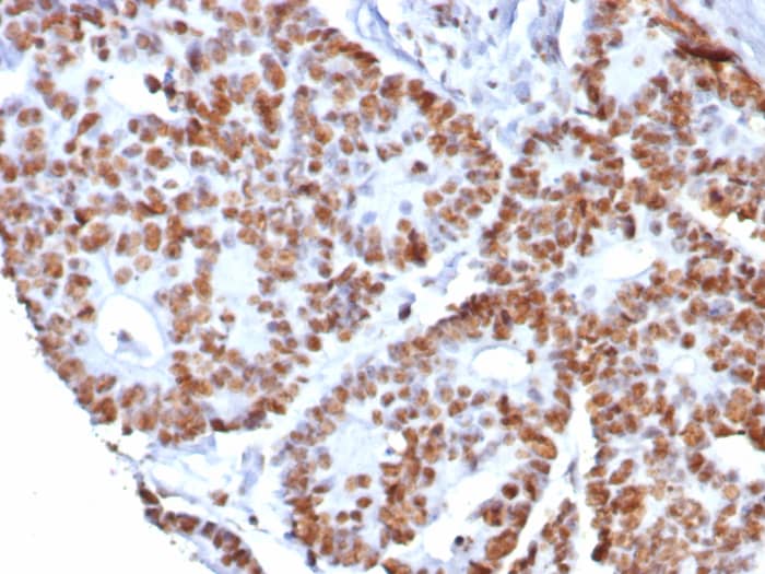 Formalin-fixed, paraffin-embedded human colon cancer stained with Nucleolin antibody (NCL/8068R). HIER: Tris/EDTA, pH9.0, 45min. Secondary: HRP-polymer, 30min. DAB, 5min.