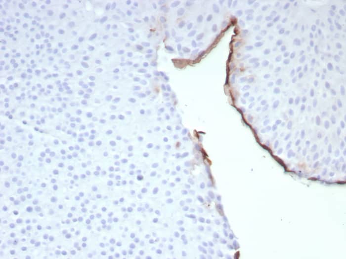 Formalin-fixed, paraffin-embedded human bladder stained with Uroplakin IIIB antibody (UPK3B/8768R). HIER: Tris/EDTA, pH9.0, 45min. Secondary: HRP-polymer, 30min. DAB, 5min.